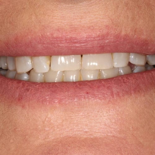 orthodontics results
